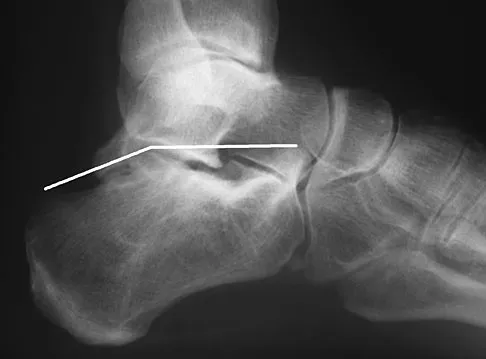 Foot & Ankle Board Review 2009: High-Yield MCQs (Set 4) - Figure 4