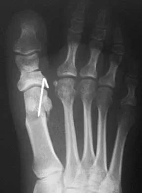 Foot & Ankle 2026 MCQs: Board Review Questions & Answers (Part 1) - Figure 111