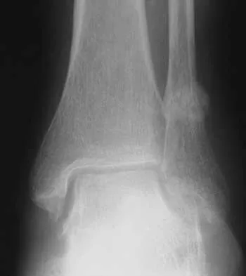 Foot & Ankle 2026 MCQs: Board Review Questions & Answers (Part 3) - Figure 3