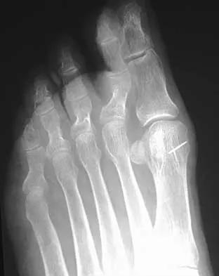 Foot & Ankle 2026 MCQs: Board Review Questions & Answers (Part 3) - Figure 35