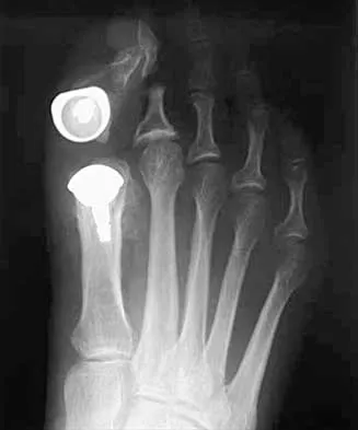 Orthopedic Foot & Ankle MCQs (Part 4): ABOS & AAOS Board Review 2026