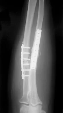 Click to enlarge General Orthopedics 2026 Practice Questions: Set 1 (Solved) - Figure 28