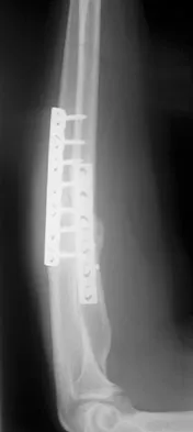 Click to enlarge General Orthopedics 2026 Practice Questions: Set 1 (Solved) - Figure 29