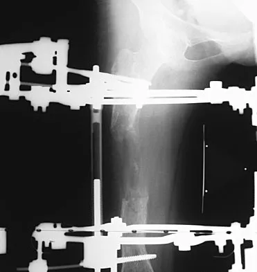 General Orthopedics Board Review 2026: High-Yield MCQs (Set 10) - Figure 95