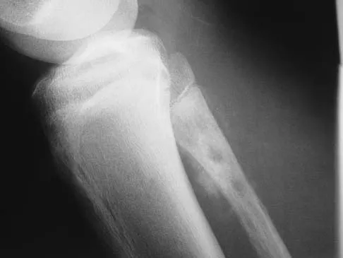 General Orthopedics Board Review 2026: High-Yield MCQs (Set 14) - Figure 33