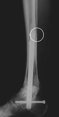 General Orthopedics Board Review 2026: High-Yield MCQs (Set 14) - Figure 49