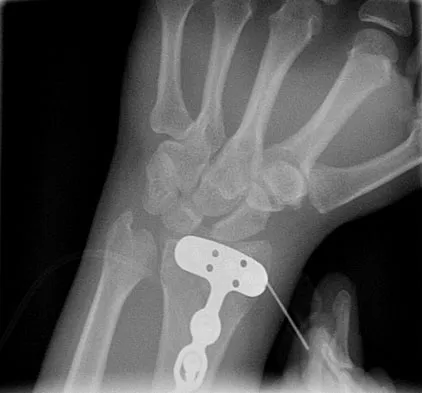 General Orthopedics Board Review 2026: High-Yield MCQs (Set 14) - Figure 85
