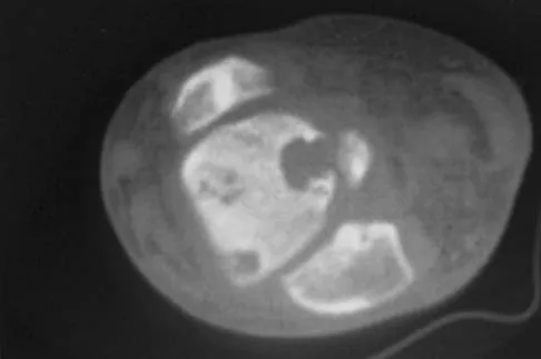 General Orthopedics Board Review 2026: High-Yield MCQs (Set 16) - Figure 56