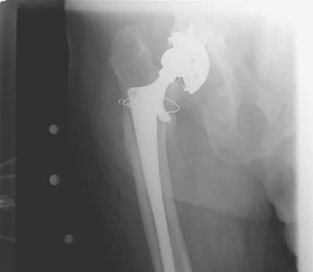 General Orthopedics Board Review 2026: High-Yield MCQs (Set 16) - Figure 92