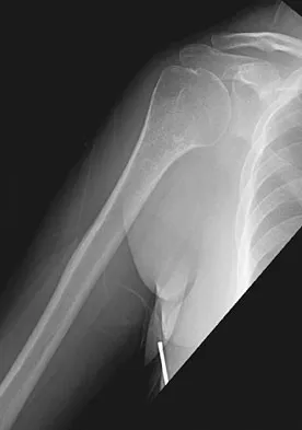 General Orthopedics Board Review 2026: High-Yield MCQs (Set 2) - Figure 108