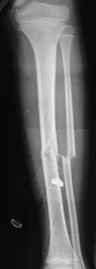 General Orthopedics Board Review 2026: High-Yield MCQs (Set 4) - Figure 37