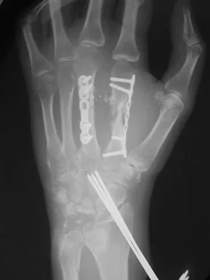 Click to enlarge General Orthopedics 2026 Practice Questions: Set 5 (Solved) - Figure 111