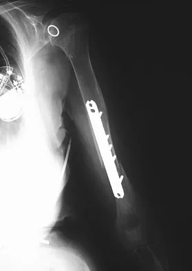 General Orthopedics Board Review 2026: High-Yield MCQs (Set 8) - Figure 89