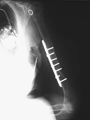 General Orthopedics Board Review 2026: High-Yield MCQs (Set 8) - Figure 90