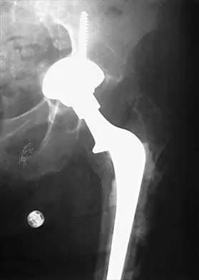 Hip Board Review 2001: High-Yield MCQs (Set 4) - Figure 6