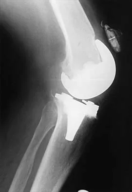 Hip Board Review 2001: High-Yield MCQs (Set 4) - Figure 8