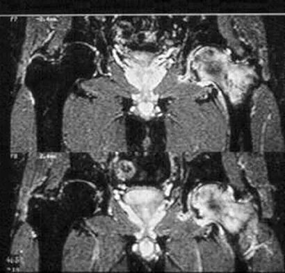 Hip Board Review 2004: High-Yield MCQs (Set 2) - Figure 3