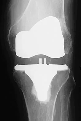 Hip Board Review 2004: High-Yield MCQs (Set 2) - Figure 4