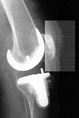 Hip Board Review 2004: High-Yield MCQs (Set 2) - Figure 5