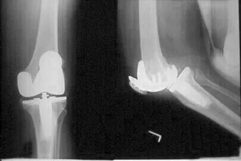 Hip Board Review 2004: High-Yield MCQs (Set 4) - Figure 8