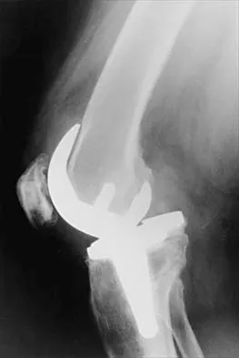 Hip 2026 MCQs: Board Review Questions & Answers (Part 1) - Figure 19