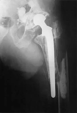 Hip 2026 MCQs: Board Review Questions & Answers (Part 1) - Figure 3