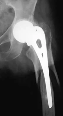 Hip 2026 MCQs: Board Review Questions & Answers (Part 1) - Figure 35