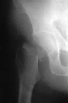 Hip 2026 MCQs: Board Review Questions & Answers (Part 1) - Figure 37