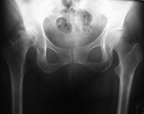 Hip 2026 MCQs: Board Review Questions & Answers (Part 1) - Figure 41