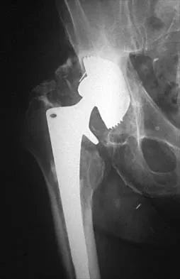 Hip 2026 MCQs: Board Review Questions & Answers (Part 1) - Figure 59