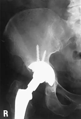 Hip 2026 MCQs: Board Review Questions & Answers (Part 1) - Figure 75