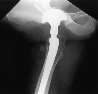 Hip 2026 MCQs: Board Review Questions & Answers (Part 1) - Figure 79