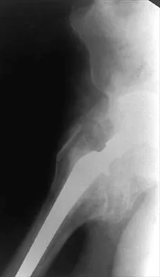 Hip 2026 MCQs: Board Review Questions & Answers (Part 1) - Figure 83