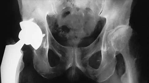 Hip 2026 MCQs: Board Review Questions & Answers (Part 2) - Figure 5