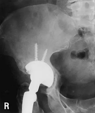 Hip 2026 MCQs: Board Review Questions & Answers (Part 2) - Figure 69