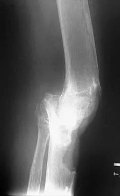 Hip 2026 MCQs: Board Review Questions & Answers (Part 4) - Figure 23