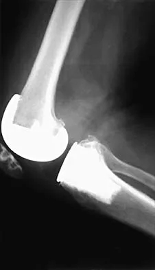 Hip 2026 MCQs: Board Review Questions & Answers (Part 4) - Figure 31