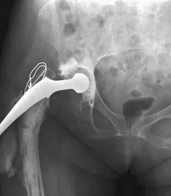 Hip & Knee Reconstruction 2007 Practice Questions: Set 1 (Solved) - Figure 11