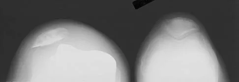 Hip & Knee Reconstruction 2007 Practice Questions: Set 1 (Solved) - Figure 14