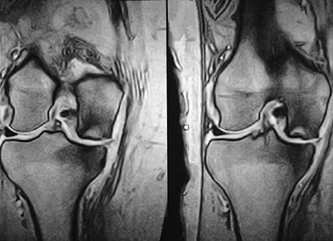 Hip & Knee Reconstruction 2007 Practice Questions: Set 1 (Solved) - Figure 21