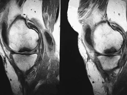 Hip & Knee Reconstruction 2007 Practice Questions: Set 1 (Solved) - Figure 22