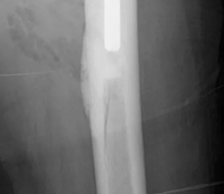 Hip & Knee Reconstruction 2007 Practice Questions: Set 1 (Solved) - Figure 23