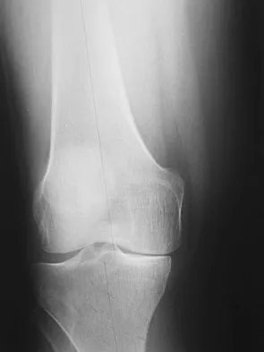 Hip & Knee Reconstruction 2007 Practice Questions: Set 1 (Solved) - Figure 29