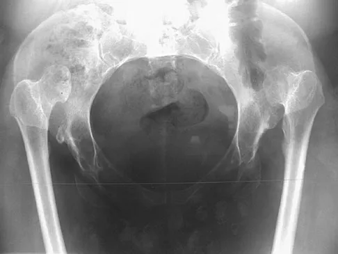 Hip & Knee Reconstruction 2007 Practice Questions: Set 1 (Solved) - Figure 4