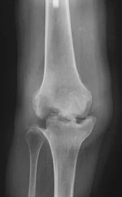 Click to enlarge Hip & Knee Reconstruction 2007 Practice Questions: Set 1 (Solved) - Figure 8