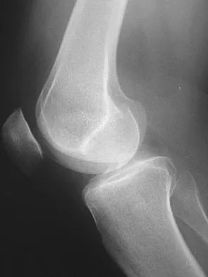 Hip & Knee Reconstruction Board Review 2007: High-Yield MCQs (Set 2) - Figure 13