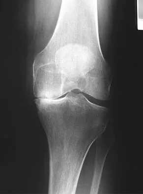 Hip & Knee Reconstruction Board Review 2007: High-Yield MCQs (Set 2) - Figure 2