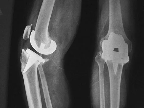 Hip & Knee Reconstruction Board Review 2007: High-Yield MCQs (Set 2) - Figure 21