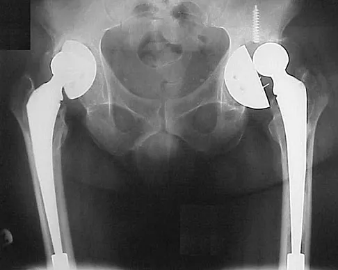 Hip & Knee Reconstruction Board Review 2007: High-Yield MCQs (Set 2) - Figure 23