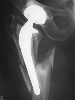 Hip & Knee Reconstruction Board Review 2007: High-Yield MCQs (Set 2) - Figure 3